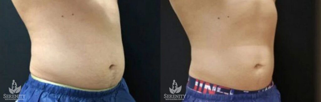 CoolSculpting before and after photo by Dr. Stephen O’Connell in Bellevue, WA