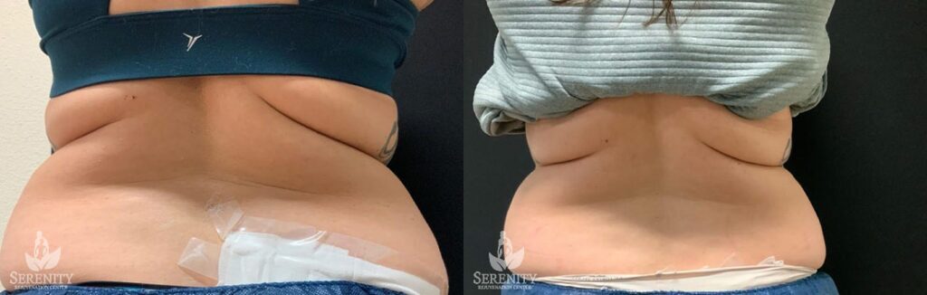 CoolSculpting before and after photo by Dr. Stephen O’Connell in Bellevue, WA