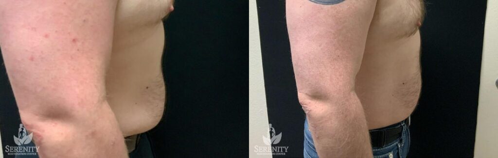 CoolSculpting before and after photo by Dr. Stephen O’Connell in Bellevue, WA