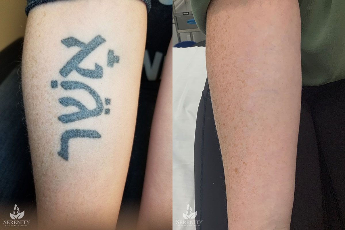 PicoSure Tattoo Removal before and after photo by Dr. Stephen O’Connell in Bellevue, WA