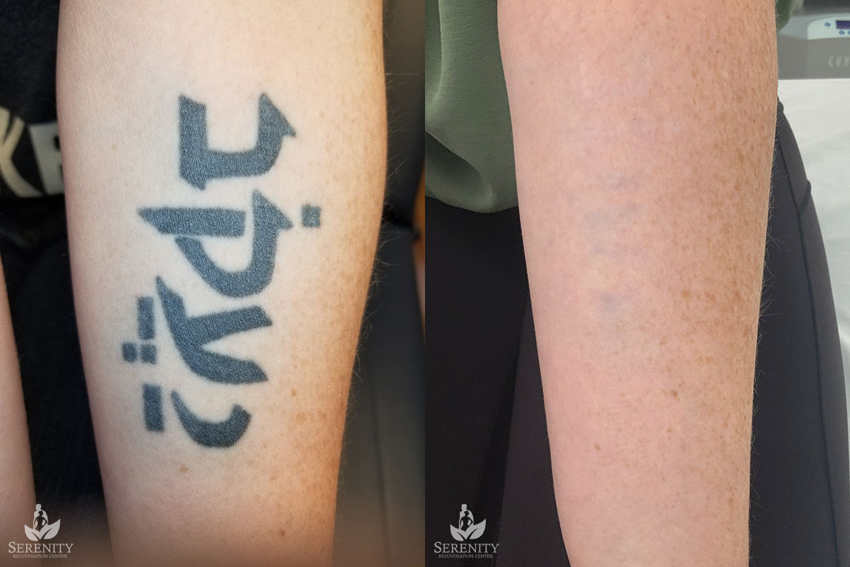 PicoSure Tattoo Removal before and after photo by Dr. Stephen O’Connell in Bellevue, WA