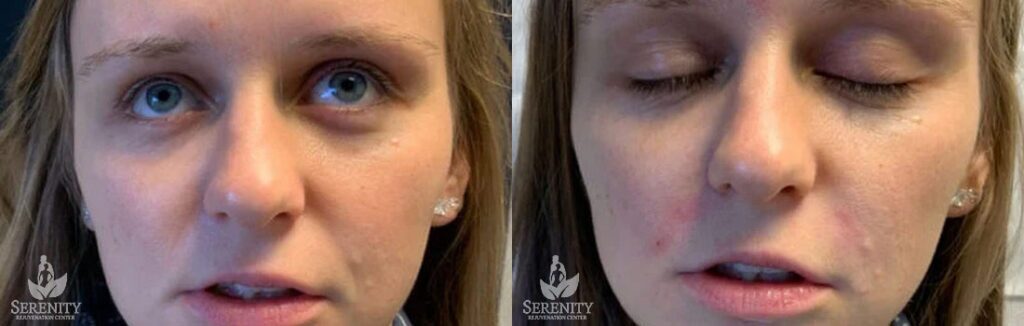 Dermal Fillers before and after photo by Dr. Stephen O’Connell in Bellevue, WA