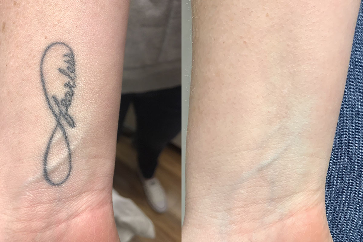 Best PicoSure Tattoo Removal Results – Bellevue, Seattle