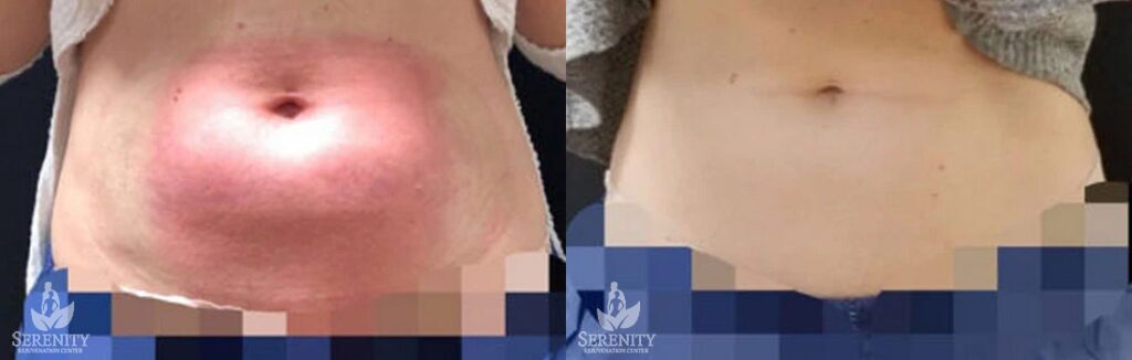 CoolSculpting before and after photo by Dr. Stephen O’Connell in Bellevue, WA