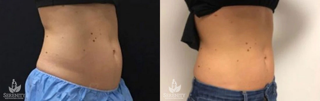 CoolSculpting before and after photo by Dr. Stephen O’Connell in Bellevue, WA