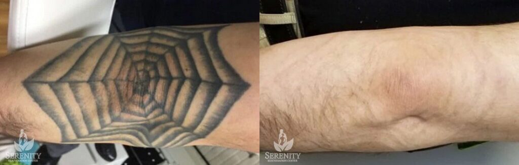 PicoSure Tattoo Removal before and after photo by Dr. Stephen O’Connell in Bellevue, WA