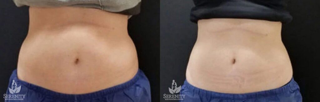 CoolSculpting before and after photo by Dr. Stephen O’Connell in Bellevue, WA