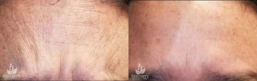 Botox before and after photo by Dr. Stephen O’Connell in Bellevue, WA