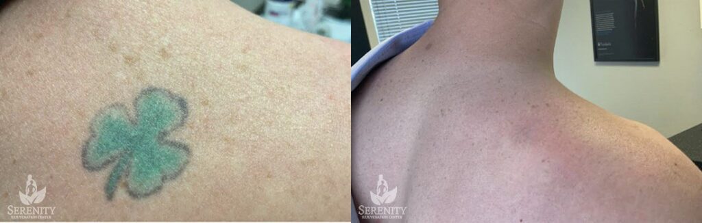 PicoSure Tattoo Removal before and after photo by Dr. Stephen O’Connell in Bellevue, WA