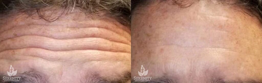 Botox before and after photo by Dr. Stephen O’Connell in Bellevue, WA