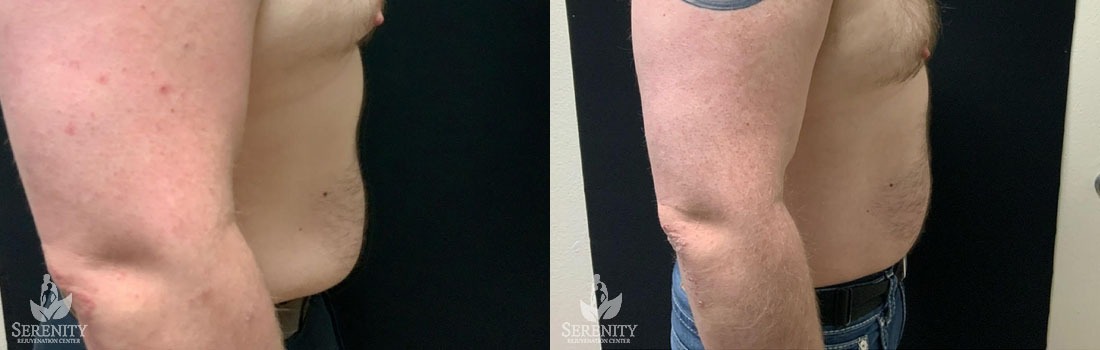 CoolSculpting before and after photo by Dr. Stephen O’Connell in Bellevue, WA