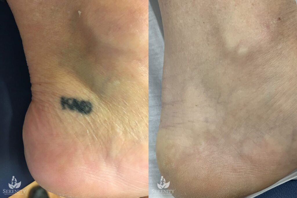 PicoSure Tattoo Removal before and after photo by Dr. Stephen O’Connell in Bellevue, WA