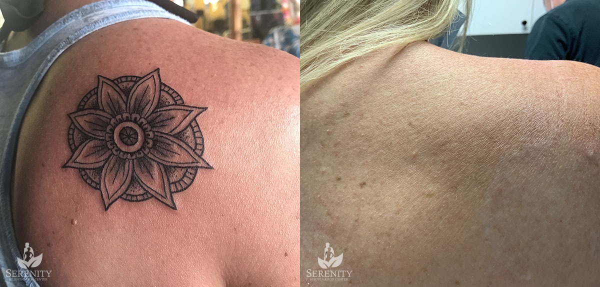 PicoSure Tattoo Removal before and after photo by Dr. Stephen O’Connell in Bellevue, WA