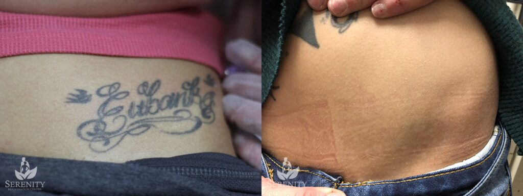 PicoSure Tattoo Removal before and after photo by Dr. Stephen O’Connell in Bellevue, WA