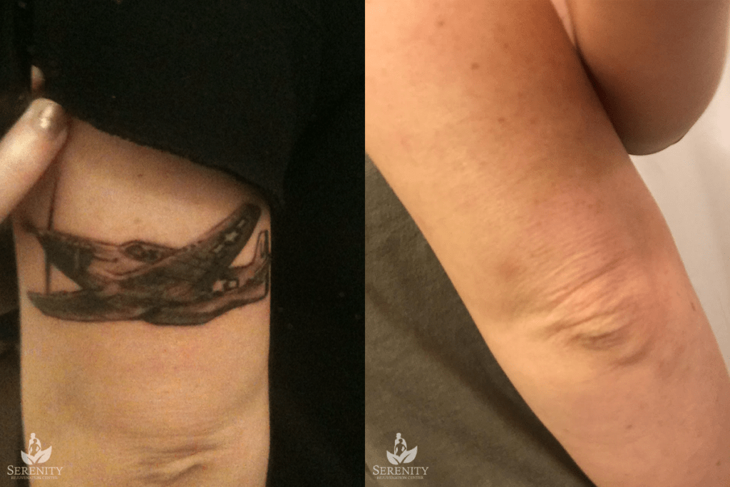 PicoSure Tattoo Removal before and after photo by Dr. Stephen O’Connell in Bellevue, WA