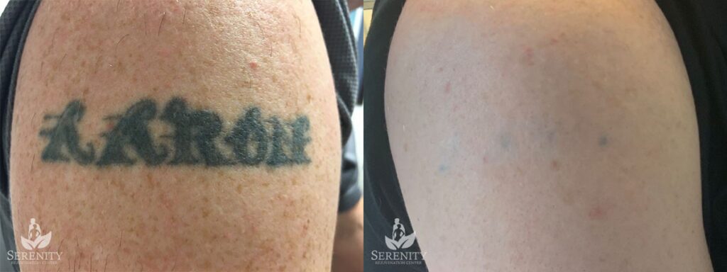 PicoSure Tattoo Removal before and after photo by Dr. Stephen O’Connell in Bellevue, WA