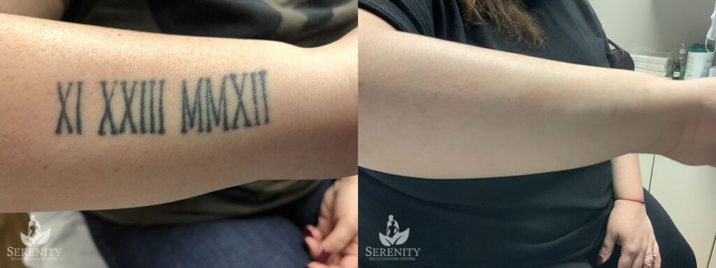 PicoSure Tattoo Removal before and after photo by Dr. Stephen O’Connell in Bellevue, WA