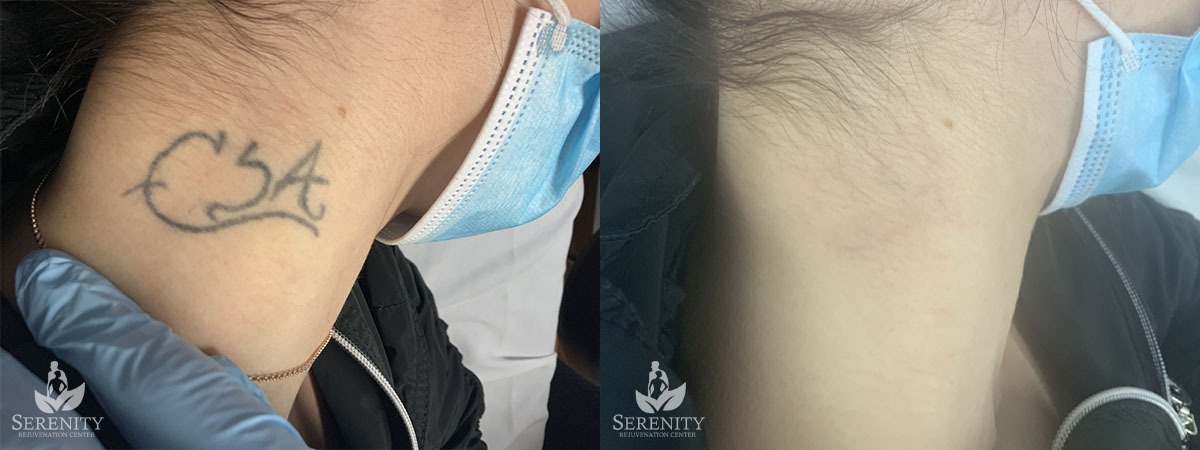 PicoSure Tattoo Removal before and after photo by Dr. Stephen O’Connell in Bellevue, WA