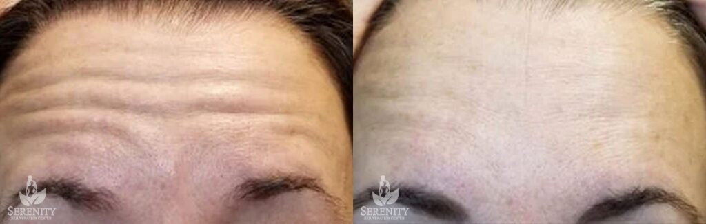 Botox before and after photo by Dr. Stephen O’Connell in Bellevue, WA