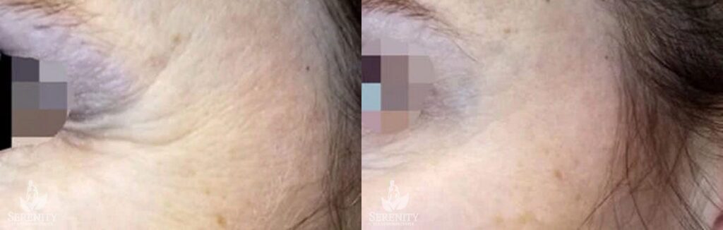 Botox before and after photo by Dr. Stephen O’Connell in Bellevue, WA