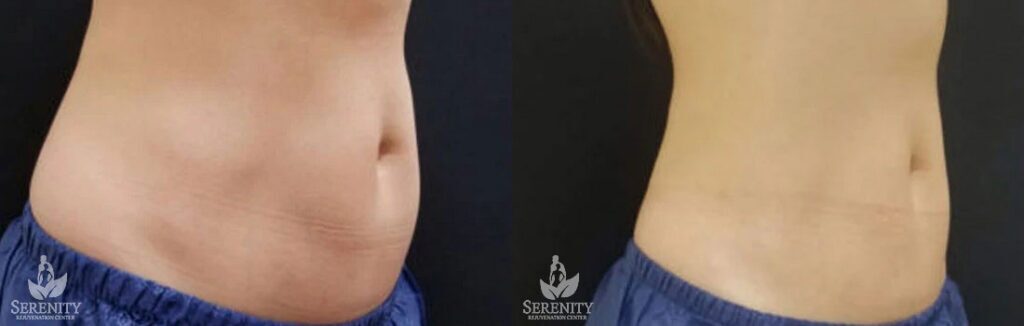 CoolSculpting before and after photo by Dr. Stephen O’Connell in Bellevue, WA