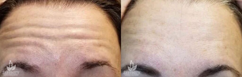 Botox before and after photo by Dr. Stephen O’Connell in Bellevue, WA