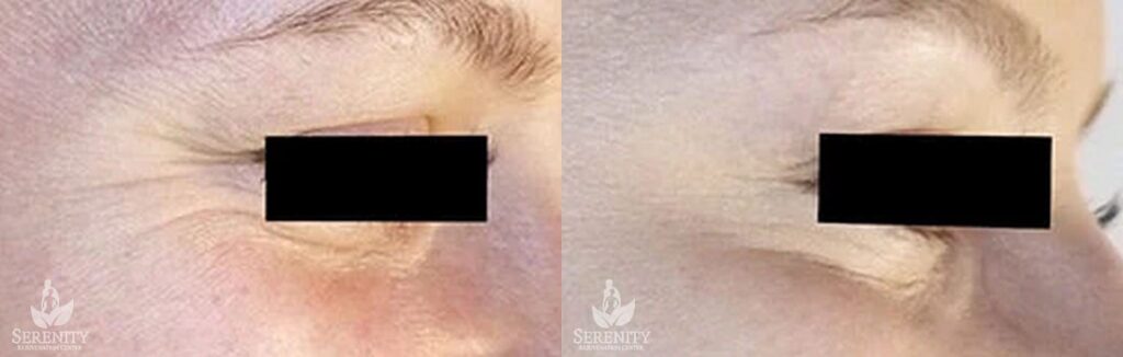 Botox before and after photo by Dr. Stephen O’Connell in Bellevue, WA