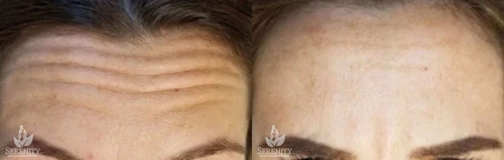 Botox before and after photo by Dr. Stephen O’Connell in Bellevue, WA