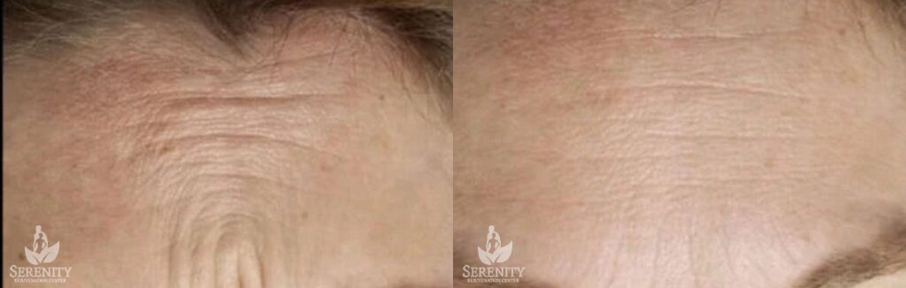 Botox before and after photo by Dr. Stephen O’Connell in Bellevue, WA