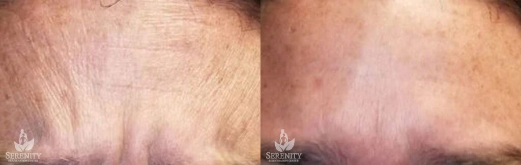 Botox before and after photo by Dr. Stephen O’Connell in Bellevue, WA