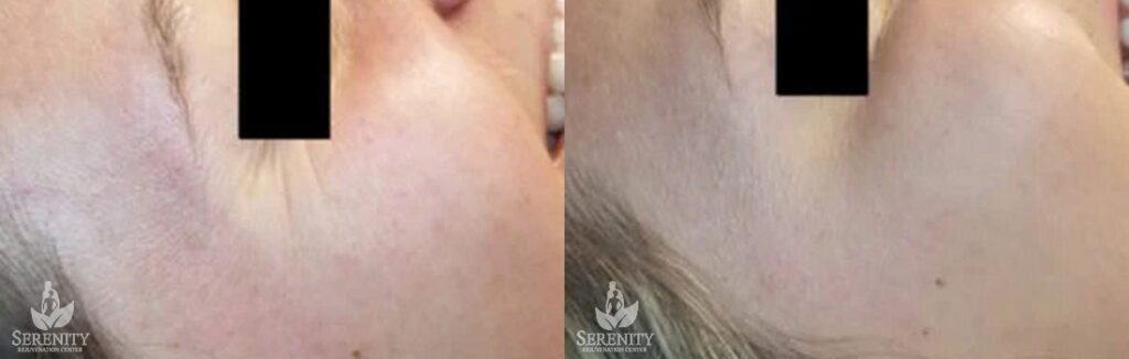 Botox before and after photo by Dr. Stephen O’Connell in Bellevue, WA