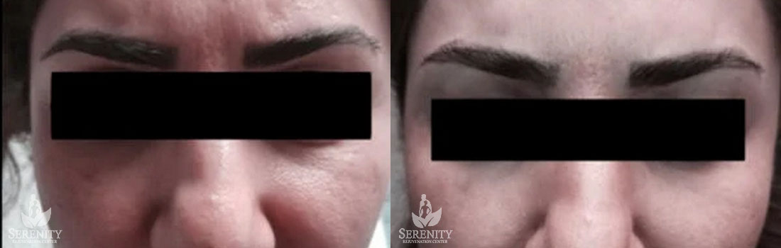 Botox before and after photo by Dr. Stephen O’Connell in Bellevue, WA