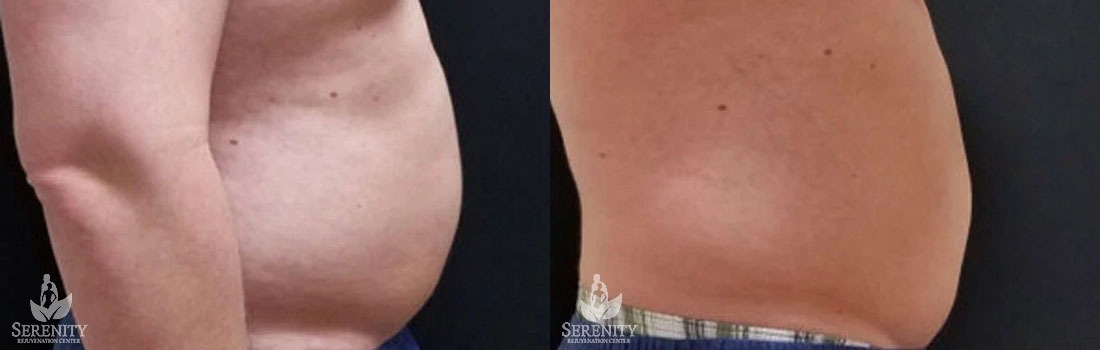 CoolSculpting before and after photo by Dr. Stephen O’Connell in Bellevue, WA