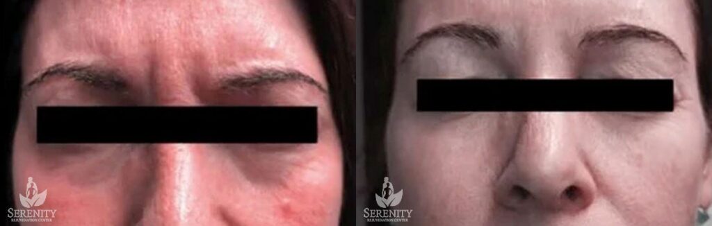 Botox before and after photo by Dr. Stephen O’Connell in Bellevue, WA