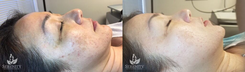 PicoSure® Pro Focus before and after photo by Dr. Stephen O’Connell in Bellevue, WA