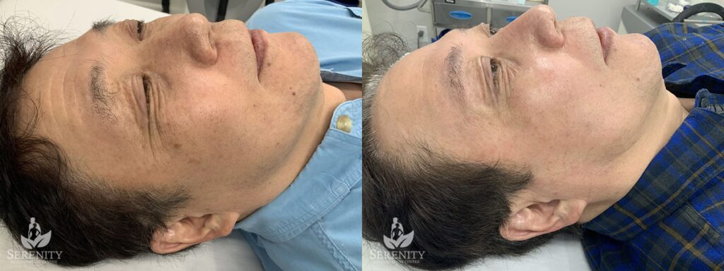 PicoSure® Pro Focus before and after photo by Dr. Stephen O’Connell in Bellevue, WA