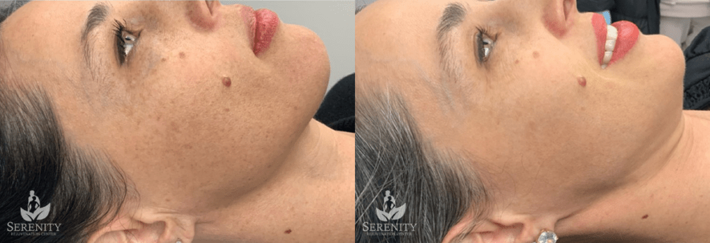 PicoSure® Pro Focus before and after photo by Dr. Stephen O’Connell in Bellevue, WA