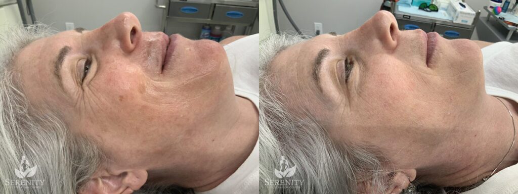 PicoSure® Pro Focus before and after photo by Dr. Stephen O’Connell in Bellevue, WA