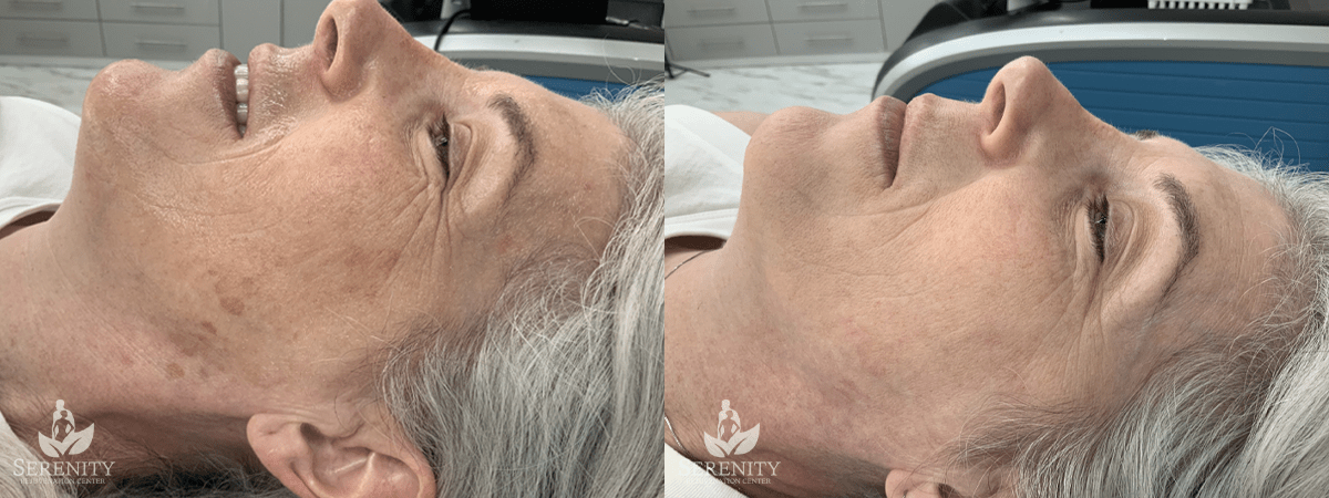 PicoSure® Pro Focus before and after photo by Dr. Stephen O’Connell in Bellevue, WA