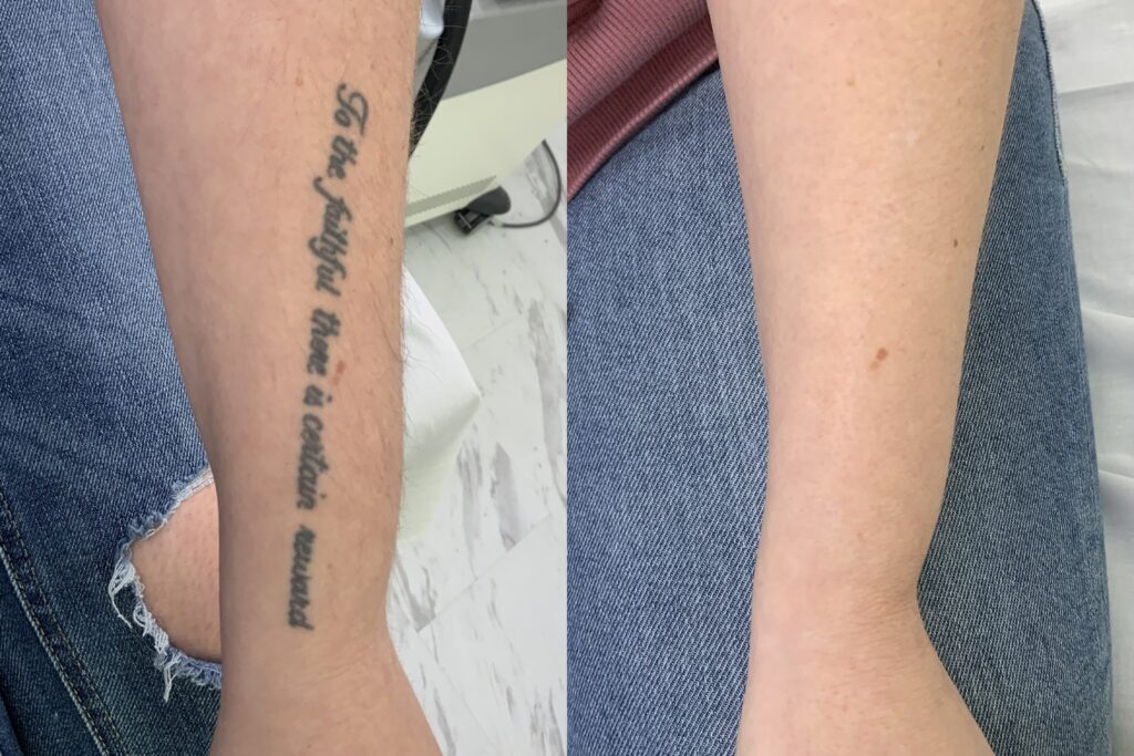 PicoSure Tattoo Removal before and after photo by Dr. Stephen O’Connell in Bellevue, WA