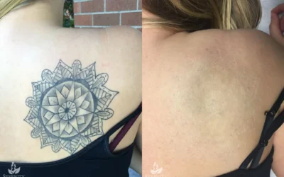 PicoSure Tattoo Removal before and after photo by Dr. Stephen OConnell in Bellevue WA