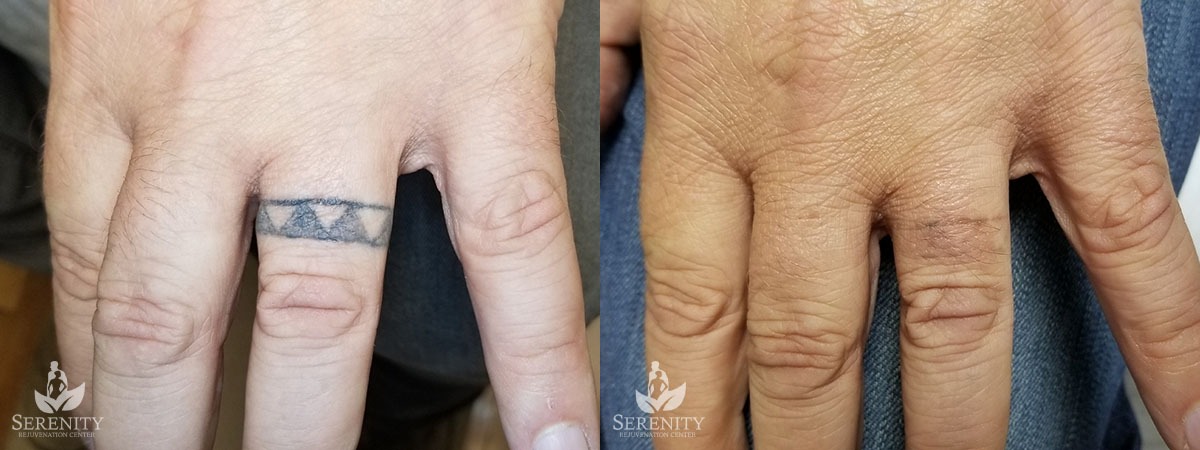 PicoSure Tattoo Removal before and after photo by Dr. Stephen O’Connell in Bellevue, WA