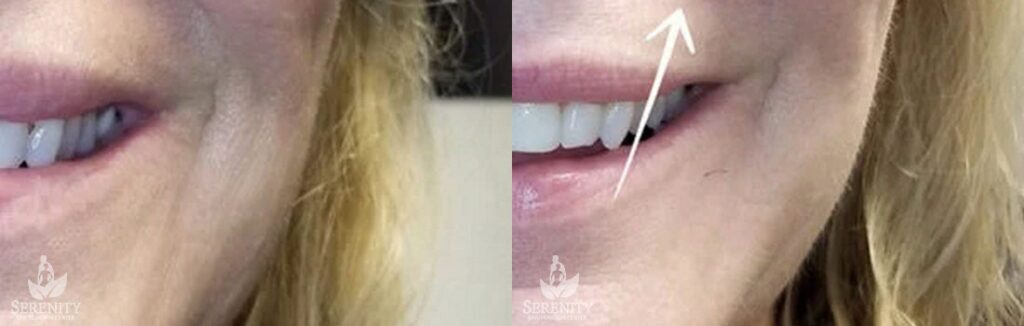 Dermal Fillers before and after photo by Dr. Stephen O’Connell in Bellevue, WA