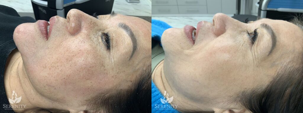 PicoFocus before and after photo by Dr. Stephen O’Connell in Bellevue, WA