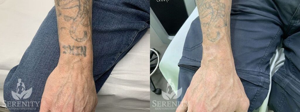 PicoSure Tattoo Removal before and after photo by Dr. Stephen Oconnell in Bellevue WA.jpg