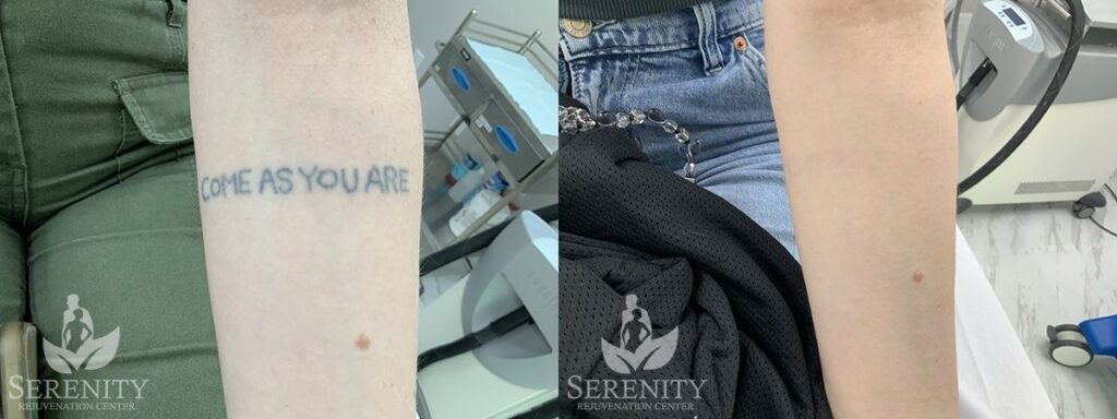 PicoSure Tattoo Removal before and after photo by Dr. Stephen Oconnell in Bellevue WA.jpg