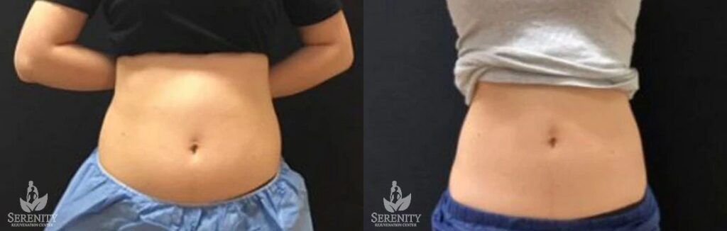 CoolSculpting before and after photo by Dr. Stephen O’Connell in Bellevue, WA