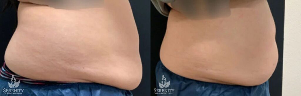 CoolSculpting before and after photo by Dr. Stephen O’Connell in Bellevue, WA