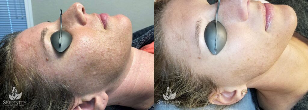 PicoSure® Pro Focus before and after photo by Dr. Stephen O’Connell in Bellevue, WA