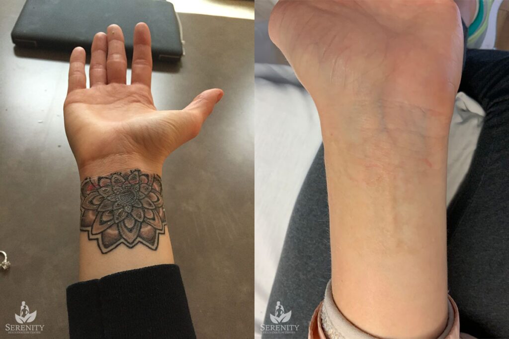 PicoSure Tattoo Removal before and after photo by Dr. Stephen O’Connell in Bellevue, WA